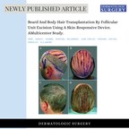 تقنية جديدة تغيير من مفهوم علاج الصلع باستخدام شعر اللحية والجسم