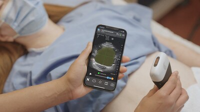 The latest addition to the Clarius AI portfolio, Clarius Bladder AI accurately measures bladder volume and provides real-time feedback to clinicians. It is particularly useful for monitoring urinary retention and assessing bladder emptying in patients with neurogenic bladder or urinary tract obstruction.
