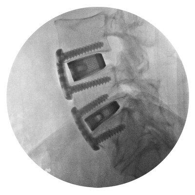 Post-operative lateral image of 2-level ALIF using F3D ALIF cage and 2-screw ALIF plate