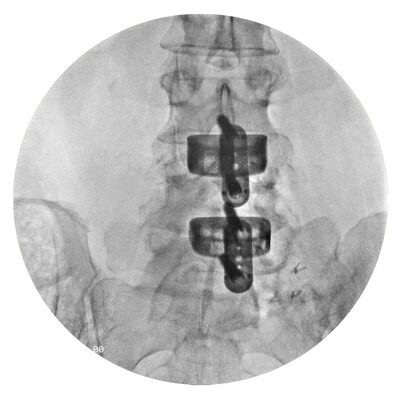 Post-operative AP view of 2-level ALIF using F3D ALIF cage and 2-screw ALIF plate
