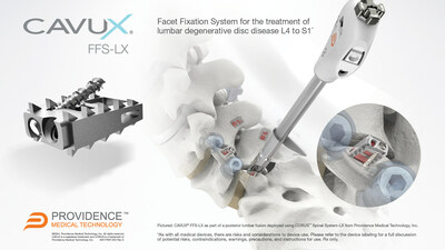 CAVUX FFS-LX (Facet Fixation System, Lumbar) is a novel integrated cage and screw system to treat lumbar degenerative disc disease that is now FDA-cleared for use in lumbar spinal fusion surgery.