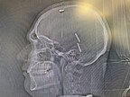 PHOTOS: Postoperative CT imaging shows electrode placement into the bilateral nucleus accumbens in enrolled patient suffering from refractory opioid use disorder.