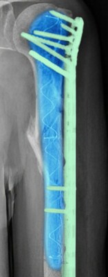 A humerus fragility fracture treated with IlluminOss (in blue) and a traditional plate with screws. 2-months after surgery, the patient reported no pain and good range of motion.