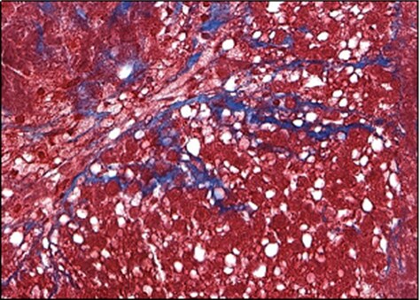 Trailblazing work with 3D Human Liver Models Yields Accurate MASH (formerly NASH) Phenotype - Vimarsana News