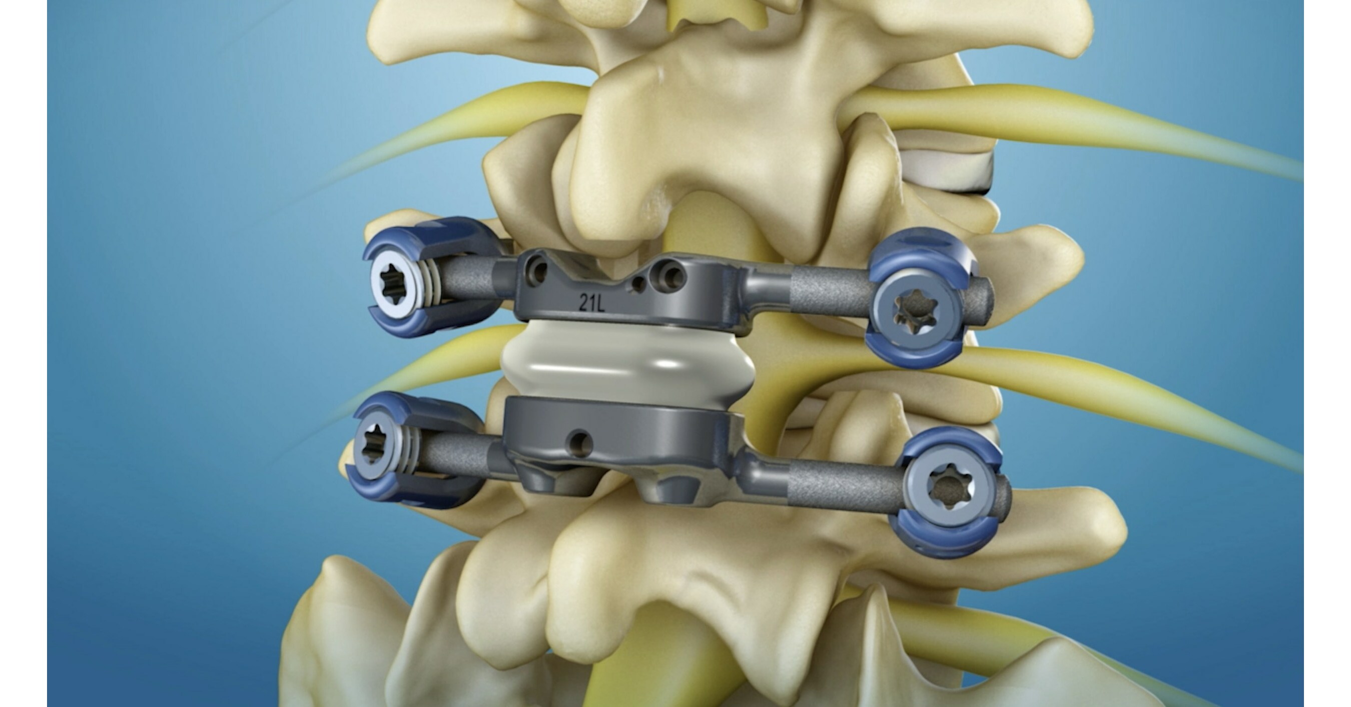 New Study Reveals CostEffective Lumbar Facet Arthroplasty For