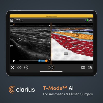 Powered by artificial intelligence (AI), T-Mode™ AI helps new scanners learn ultrasound anatomy by creating a split screen during an exam that displays a colorful anatomical image with labels next to the grayscale ultrasound image. Users can learn quickly by matching grayscale images with the images produced by T-Mode.