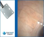 CorNeat EverPatch Hits the US Market: Farewell to Traditional Ocular Tissue Grafts