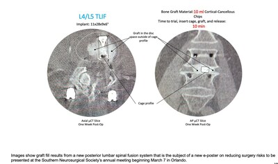 Images show graft fill results from a new posterior lumbar spinal fusion system that is the subject of a new e-poster on reducing surgery risks to be presented at the Southern Neurosurgical Society’s annual meeting beginning March 7 in Orlando.