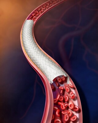 BD today announced the enrollment of the first patient in the investigational device exemption study, “AGILITY,” which will assess the safety and effectiveness of the BD Vascular Covered Stent for the treatment of Peripheral Arterial Disease