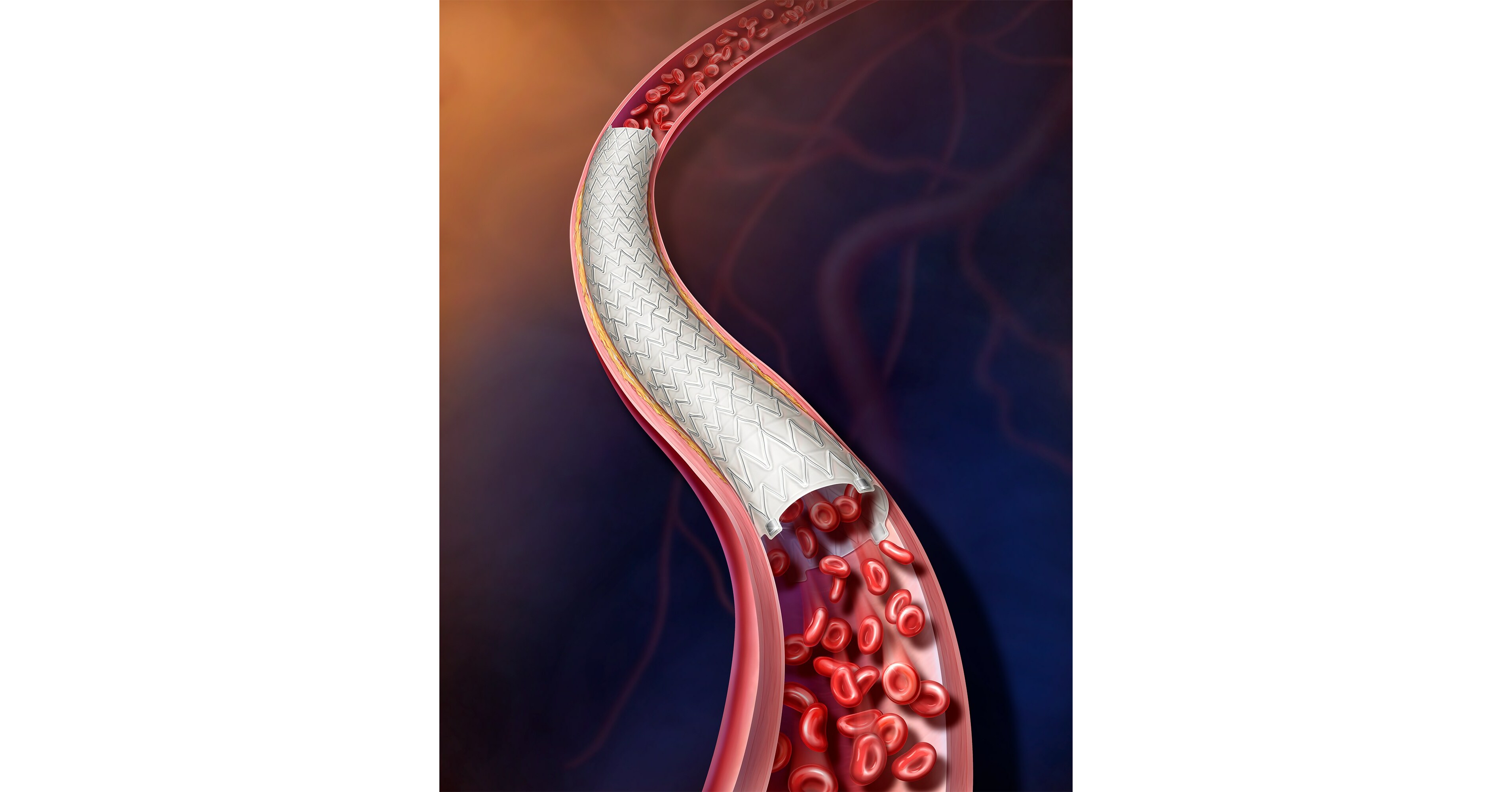 BD Initiates International Study to Expand Treatment Options for Patients  with Peripheral Arterial Disease