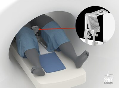 Rendering of the CLEAR GUIDE SCENERGYtm Device. (2024)