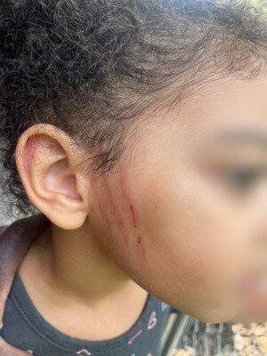 The mother of a 2-year-old girl is suing Spell Well Montessori School in Spring, Texas, claiming caregivers lost track of her child for an unknown amount of time at the school and then attempted to cover up the incident. The suit states Allison Pedigo's daughter suffered scratches on her face during the incident. The caregiver responsible for Pedigo's daughter and school administration provided five different versions of the incident to Pedigo and state investigators, per the complaint.