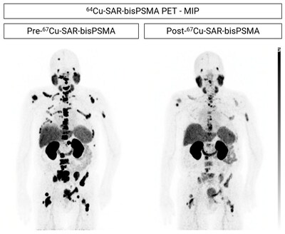 Fig 1. Participant from cohort 3 showing reduction in uptake of 64Cu-SAR-bisPSMA in prostate cancer lesions. The participant was treated with ADT, ARPI, chemotherapy and 2 investigational agents prior to enrolling in the SECuRE study (PSA 270.9 ng/ml at study entry). The participant received a single dose of 67Cu-SAR-bisPSMA (12GBq), which led to the reduction in uptake of 64Cu-SAR-bisPSMA in the lesions. PSA reduction: 92.3%.