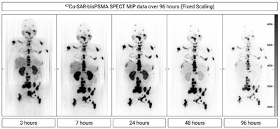Fig 3. Dosimetry assessment in a participant from cohort 3 (12GBq). SPECT was performed at different timepoints (3, 7, 24, 48 and 96 hours post-injection of 67Cu-SAR-bisPSMA). Images show fast clearance from the kidneys, compared to prolonged retention of 67Cu-SAR-bisPSMA in lesions. MIP: maximum intensity projection.
