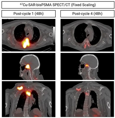 Fig 4. Same patient described in Graph 1 above (PSA reduction by 93.7%). Images show reduction in uptake of 67Cu-SAR-bisPSMA in multiple lesions (arrows) after 4 doses of 4GBq each using SPECT (images: SPECT/CT). Top images: axial view. Middle images: sagittal view. Bottom images: coronal view.