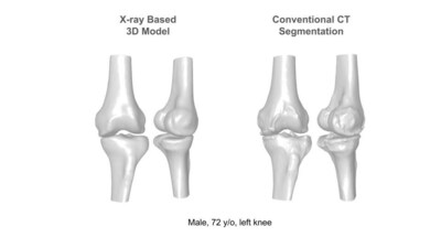 XPlan's high-fidelity X-ray based 3D knee model, compared to a conventional CT based model of the same patient.