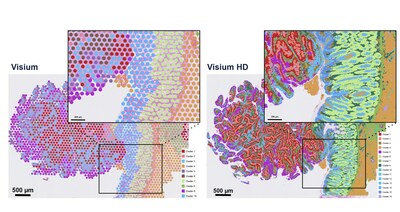 A side-by-side comparison of Visium data (left) and Visium HD data (right) in FFPE human colorectal cancer, demonstrating the discovery power of whole transcriptome spatial gene expression at single cell–scale resolution.