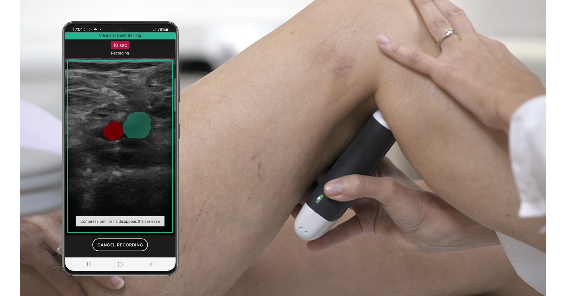 Clarius and ThinkSono Introduce a New AI-Guided Ultrasound System Enabling Rapid Assessments of DVTs