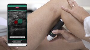 Clarius and ThinkSono Introduce a New AI-Guided Ultrasound System Enabling Rapid Assessments of DVTs