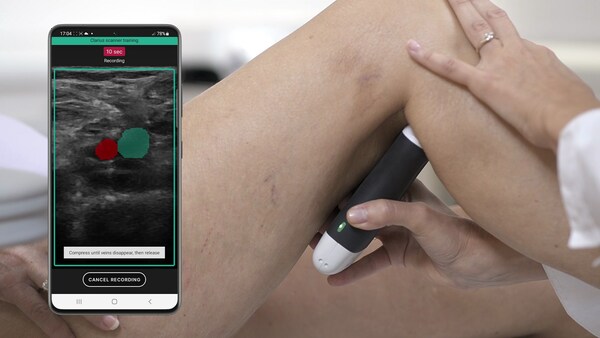 ThinkSono Guidance enables non-ultrasound trained healthcare professionals to use the Clarius handheld ultrasound scanner to collect DVT exam data for a qualified clinician to review. This can speed up the diagnosis from several hours to as little as 15 minutes. (PRNewsfoto/Clarius Mobile Health)