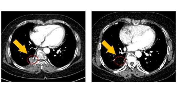 J Ints Bio, Aacr 2024 - 'jin-a02', A Novel Oral 4th Generation Egfr Tki 