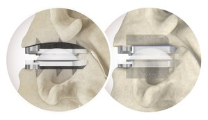 Over 5,000 Procedures Completed in U.S. with Centinel Spine's prodisc® C Vivo and prodisc C SK Cervical Total Disc Replacement System