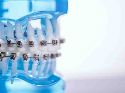 This new custom metal SL solution revolutionizes orthodontic treatment by seamlessly integrating the benefits of low-friction and non-fatiguing ligation inherent in different types of conventional SL solutions with the benefits of unparalleled control and efficiency from a custom prescription.
