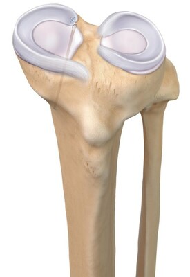 “The team is really pleased to be recognized with such a prestigious award to acknowledge this important, innovative product specifically designed to preserve the meniscus,” said Product Manager, Knee Ligament Julia Cuny. “[The SutureLoc™ implant is] a complicated anchor to produce and it provides an entirely new mechanism that we developed just for this implant. It was truly a team effort with over 20 teams contributing to the development.”