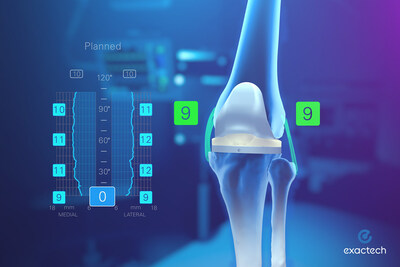 Powered by Active Intelligence, Exactech's Newton Knee technique works in concert with ExactechGPS to provide orthopaedic surgeons with dynamic soft tissue analytics, pre-resection operative insights and full-range personalized planning designed to simplify, evaluate and execute balanced total knee replacement surgery.