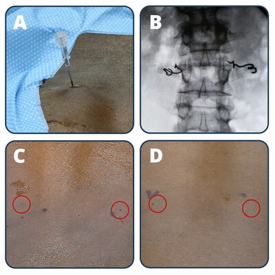 Injectrode placement and results from the LIFE study. (A) Injectrode placement using an 18-gauge needle, targeting the dorsal rami innervation of the erector spinae muscles. (B) Fluoroscopic AP view showing bilateral Injectrode placement in the lower back. (C) Placement site immediately after the procedure on day 0. (D) Placement site on day 25, demonstrating virtually invisible placement site after healing.