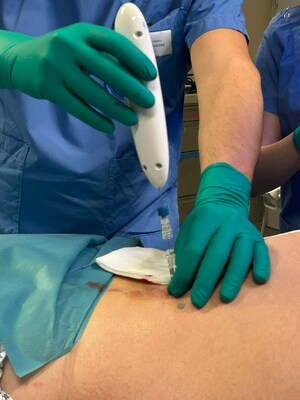 The Single Pass Kronos device being used for a kidney biopsy procedure in Rome, Italy.