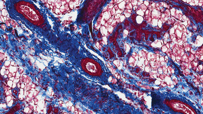 Mice with UTIs experience a significant increase in breast tissue collagen deposits. Note the blue-stained collagen “rivers” in the images above and below.