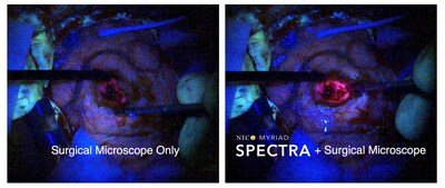 SPECTRA enables supplemental hand-held blue light close in proximity to the area of interest. When combined with the surgical microscope, it has shown enhanced visualization during surgery.