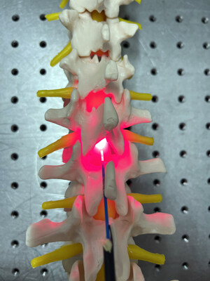 Surgery after spinal cord injury is common. The concept could offer surgeons the opportunity during the same operation to implant a device which could help protect and repair the spinal cord itself.