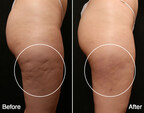 Dr. Simon Ourian Unveils New FDA-Approved Advanced Cellulite Removal Treatment