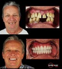Dental Tourism | The Best Dentists Option in Tijuana Mexico - Smile 4 Ever Mexico