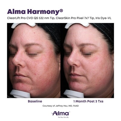 Results following a combination of treatments, the ClearLift Pro, the ClearSkin Pro and the Iris Dye-VL on the Alma Harmony multi-application workstation.