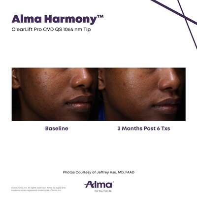 Results following treatments with the ClearLift Pro on the Alma Harmony multi-application workstation.