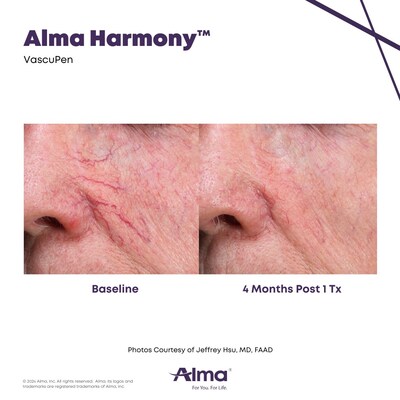 Results following treatments with the VascuPen on the Alma Harmony multi-application workstation.