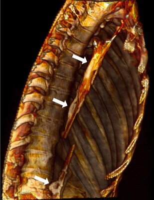 The photograph of the CT image demonstrating extensive atherosclerosis (arrows) in the aorta of the middle-aged female mummy nickname in the Peruvian town where she is housed Rosita of the Chancay culture, who lived between 1000-1470 in ancient Peru.  Published by Oxford University Press on behalf of the European Society of Cardiology (PRNewsfoto/MemorialCare)