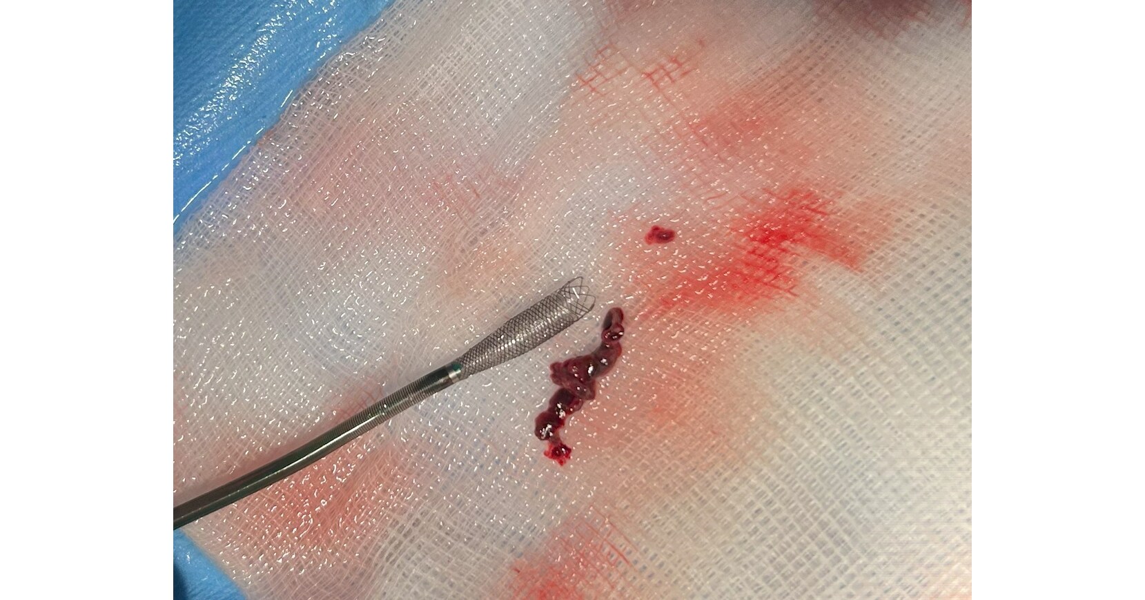 Ceretrieve Announces Groundbreaking Success in FIH Ischemic Stroke Cases