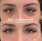 Dr. Simon Ourian Removes Dark Circles With Innovative Treatments
