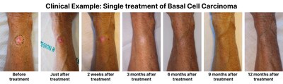 TOOsonix treatment of Basal Cell Carcinoma
