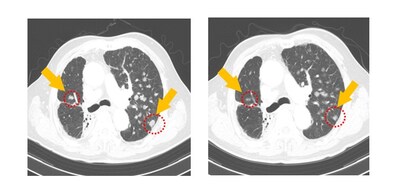 Lung CT image of PR patient in Cohort 4. Tumor lesions reduced by 35.3%