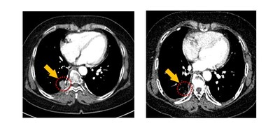 Lung CT image of PR patient in Cohort 3. Tumor lesions reduced by 77.3%