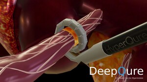 DeepQure receives IDE Approval from FDA for its EFS study to treat Resistant Hypertension with its Extravascular Renal Denervation Technology (HyperQure™)