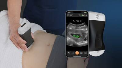 The FDA-cleared Clarius OB AI model automatically performs fetal biometry measurements to estimate fetal age, weight and growth intervals and is available now with the Clarius C3 HD3 wireless handheld ultrasound scanner in the United States and Canada.