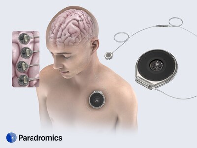 Paradromics Connexus® Direct Data Interface: Cortical modules on the brain record signals from 1600+ individual neurons, and the Internal transceiver implanted in the pectoral region provides wireless power and secure, high-bandwidth data relay. The system is designed to support the use of up to four cortical modules.