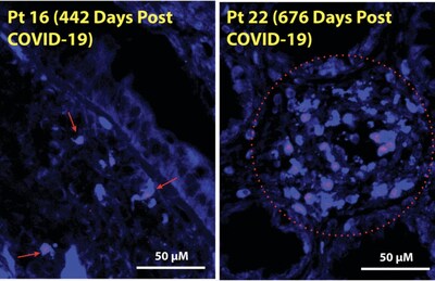 Image from the Science Translational Medicine paper: SARS-CoV-2 spike protein–encoding double-stranded RNA in long COVID gut tissue