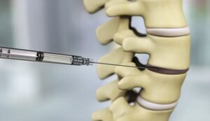 DiscGenics Announces the International Journal of Spine Surgery Has Published Results from an FDA-Approved Study of an Allogeneic Disc Progenitor Cell Therapy for the Treatment of Adults with Lumbar Disc Degeneration